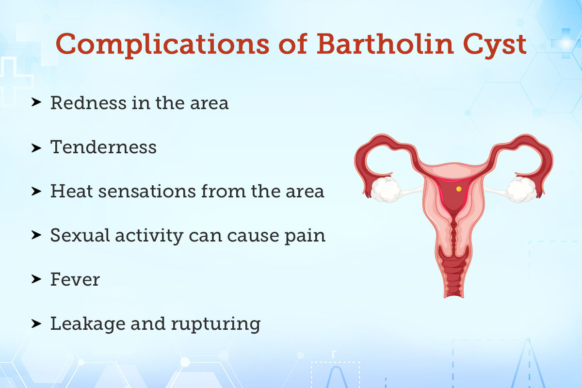 Bartholin Abscess Treatment Procedure Cost Recovery Side Effects And More